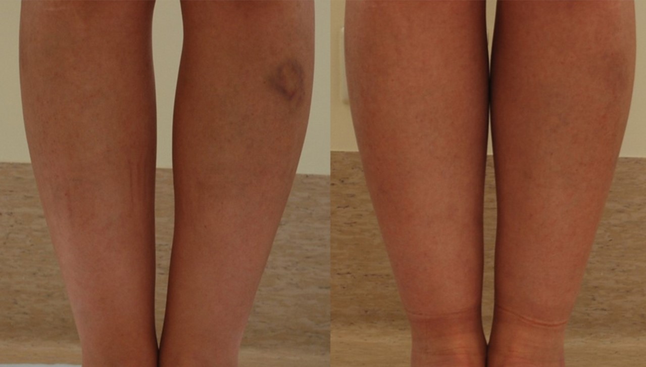 CRUROPLASTY