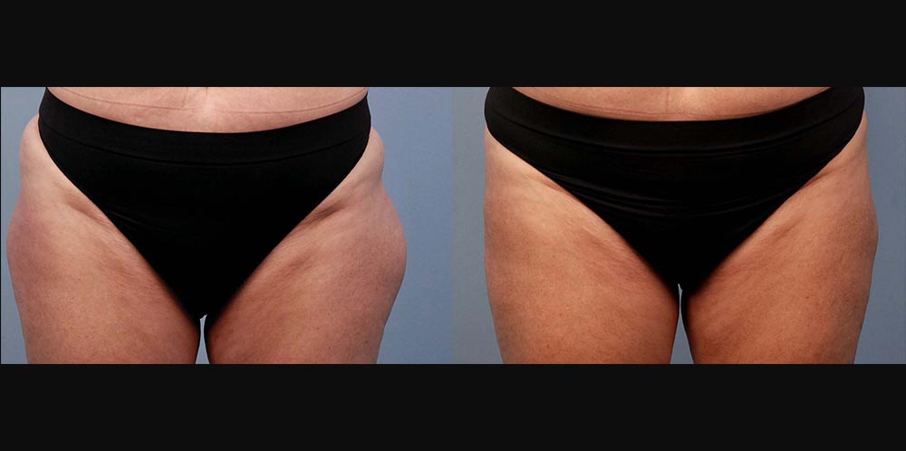 IM_Stephen-Mulholland-Thigh-6Wk
