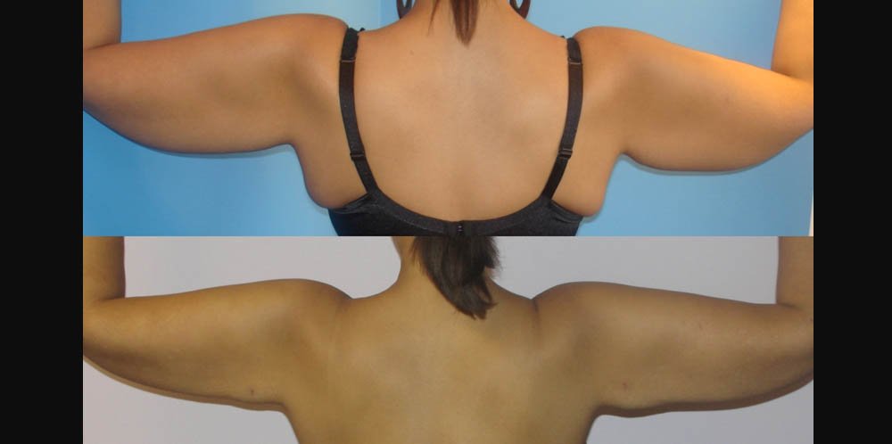 BodyTite_DH_Arms