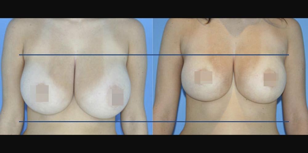BodyTite_GB_DS_Breast1