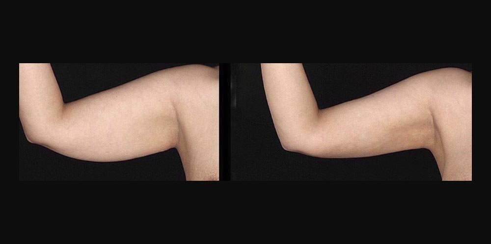 CC_ST_BodyTite_1a_Arm_noTM