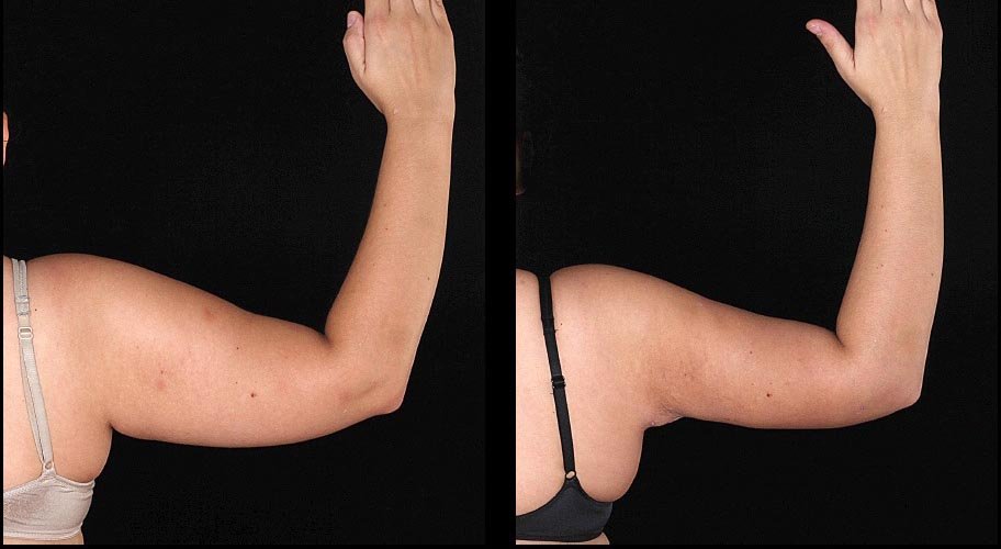 CC_ST_BodyTite_4a_Arm_noTM