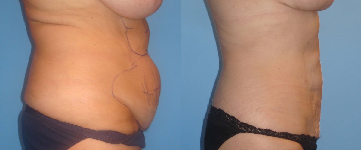 DH_BodyTite_1a_Abdomen_18Wk_LR