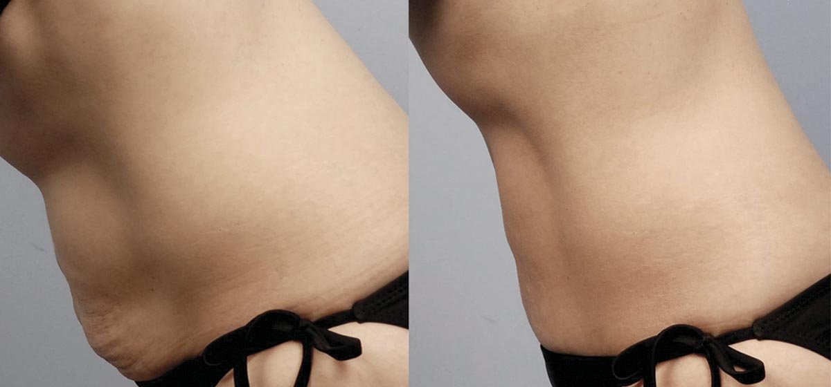 IM_SM_-MommyTummy
