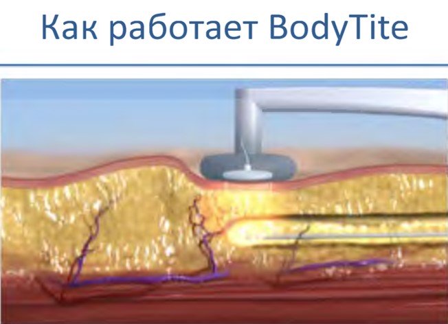 как работает аппарат bodytite