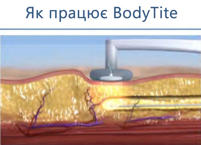 Як працює аппарат bodytite